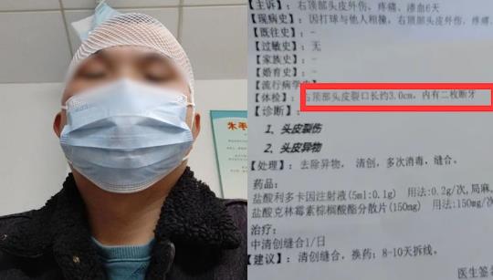 男子打球6天后頭皮里發(fā)現(xiàn)2顆牙，網(wǎng)友神評(píng)論