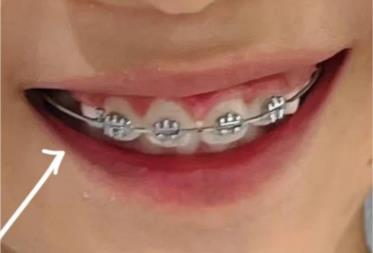 矯正牙齒可以報銷醫保嗎兒童（矯正牙齒可以報銷醫保嗎）