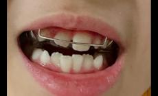 兒童矯正牙齒可以報銷嗎 兒童矯正牙齒可以用醫保卡嗎