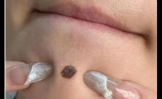 正規醫院取一顆痣多少錢 醫院祛痣一般多少錢一顆